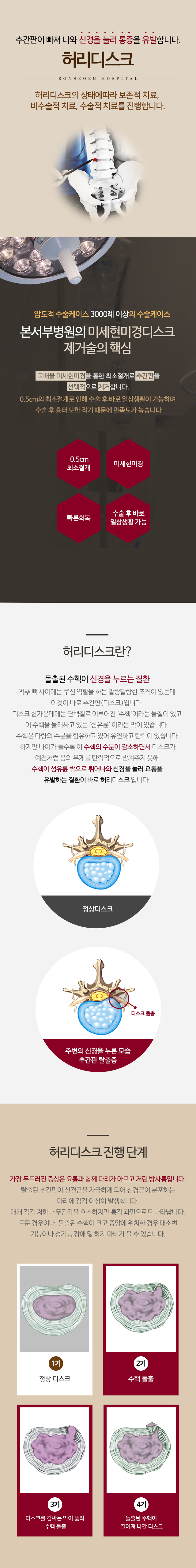 허리디스크
