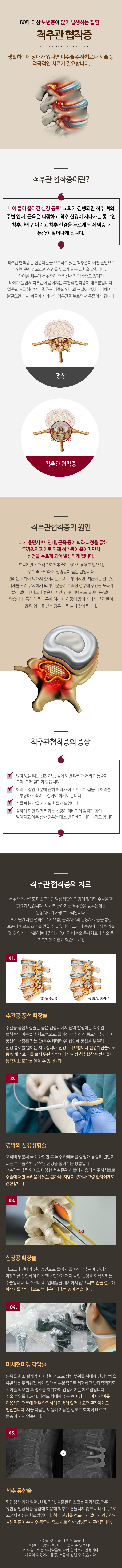 척추관 협착증