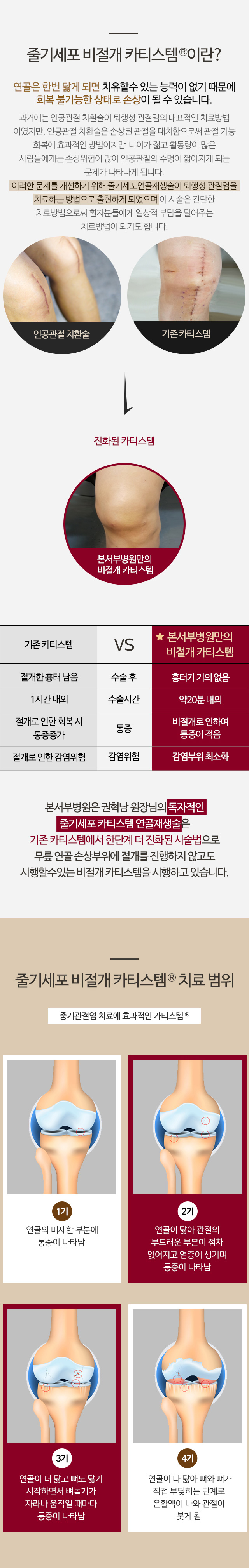 줄기세포 비절개 카티스템